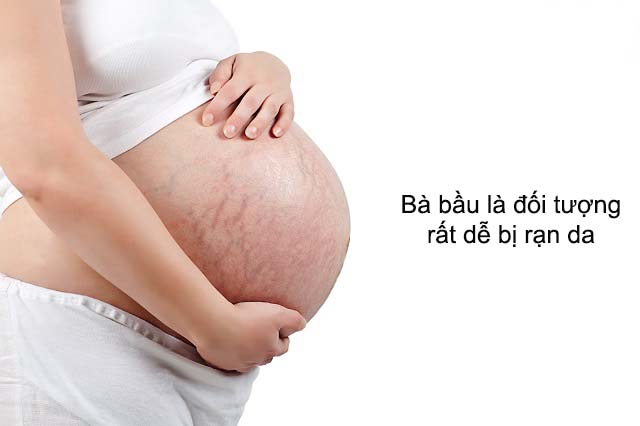 Bà bầu sau sinh là đối tượng dị rạn da